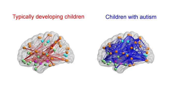 اتصالات مغزی افراد ابتلا به اوتیسم